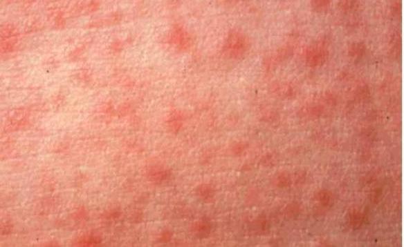 Bệnh Sởi (Measles) post thumbnail image